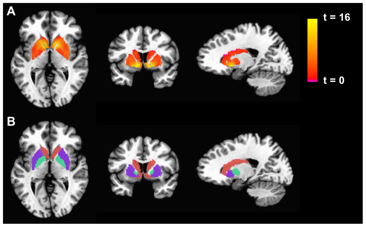Two rows of MRI brain slices with orange and purple heat-map blobs overlaid, beside a calibrated colour scale